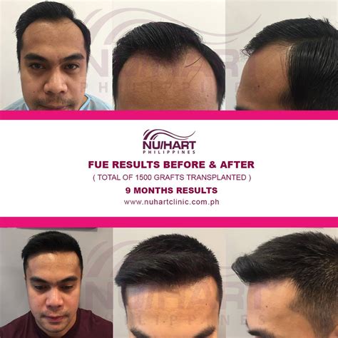 hair transplant cebu|Nu/Hart Hair Restoration Philippines .